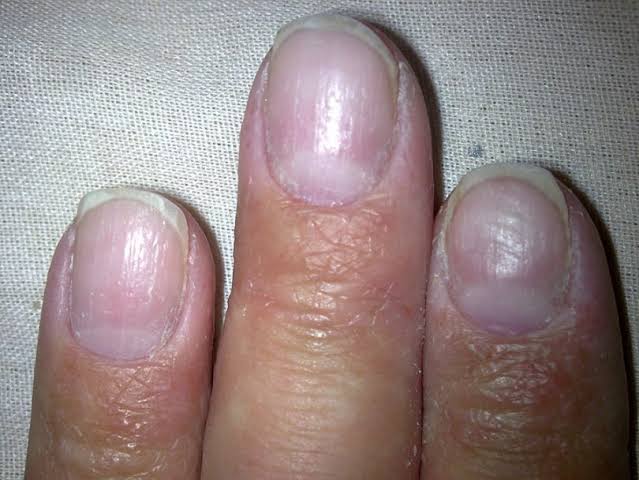 O que Pode Ser Quando as Unhas Ficam Roxas: Entenda os Sinais da Sua Saúde